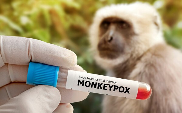 Rusiyanın daha bir şəhərində meymunçiçəyinə yoluxma qeydə alındı